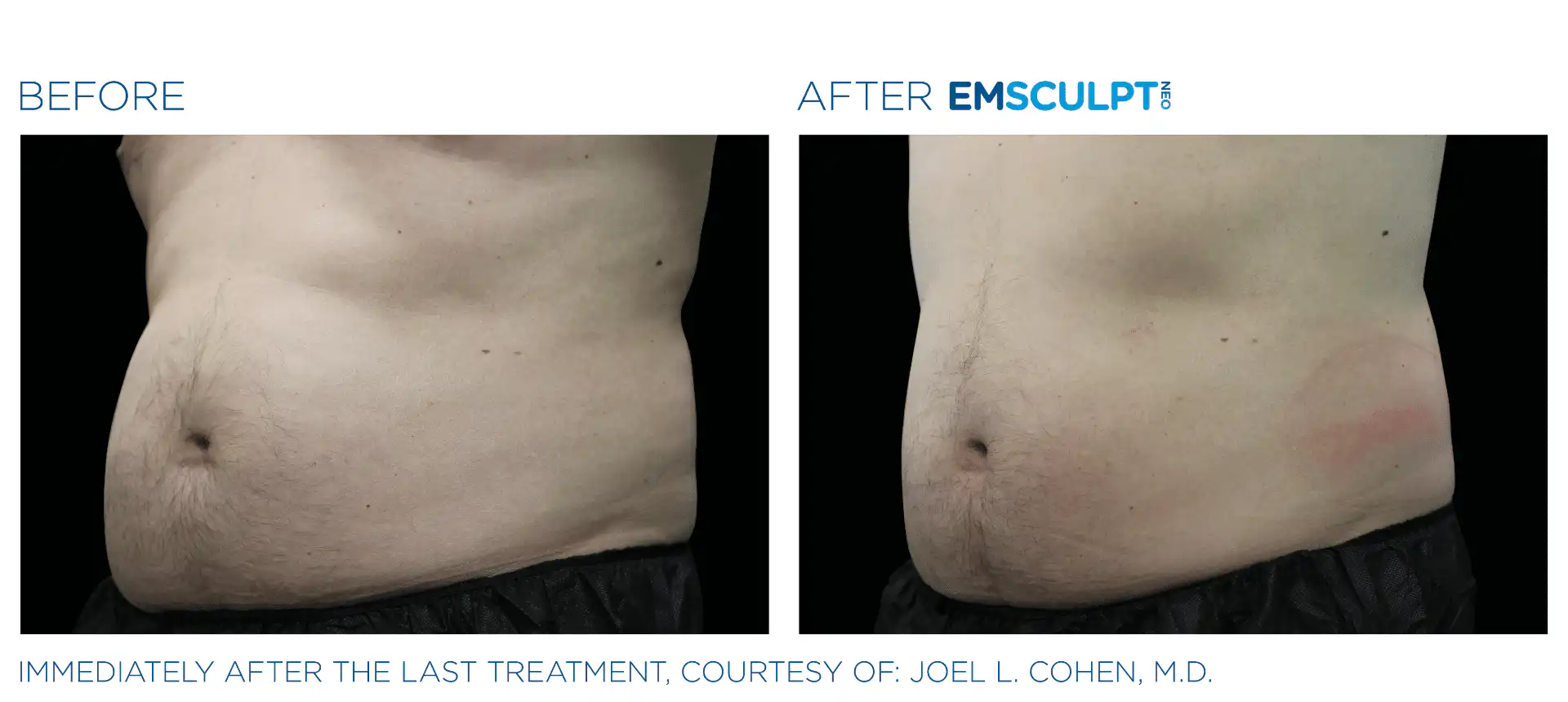 Emsculpt NEO Before & After Eastchester Medical associates, Bronx NYC