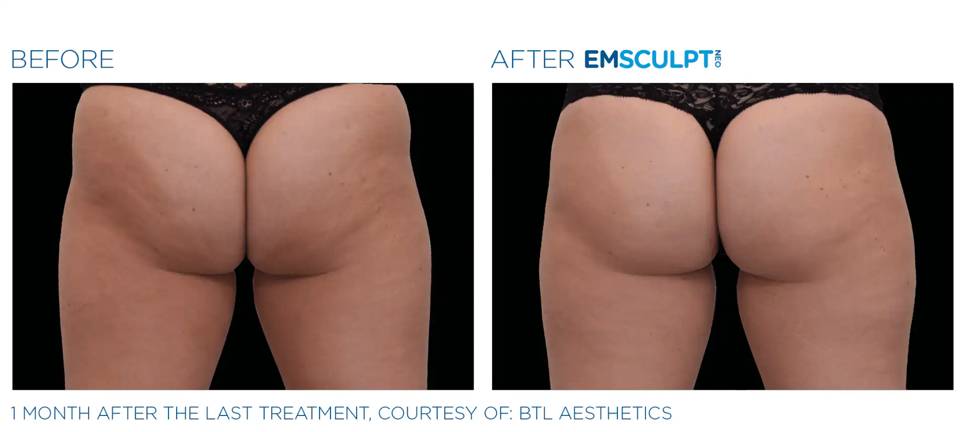 Emsculpt NEO near me Bronx, NYC