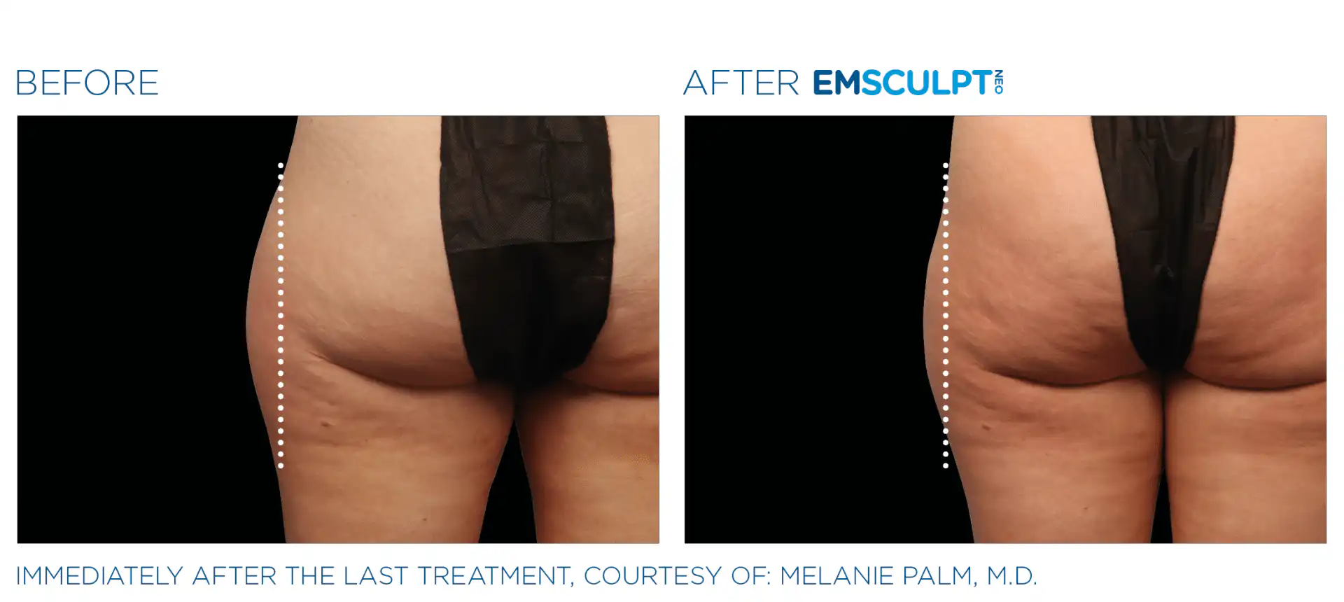 Emsculpt NEO results in Bronx, NYC