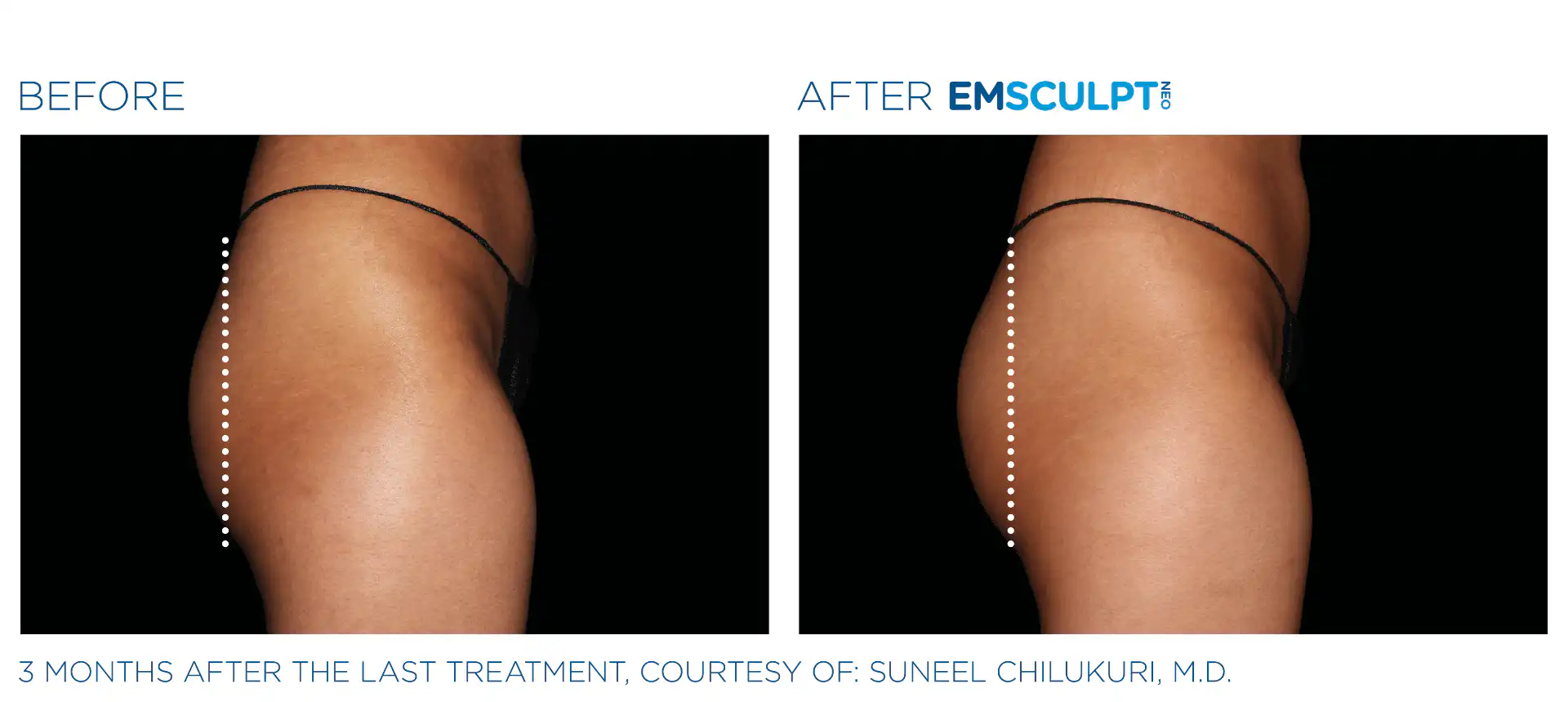 Emsculpt in Bronx, NYC