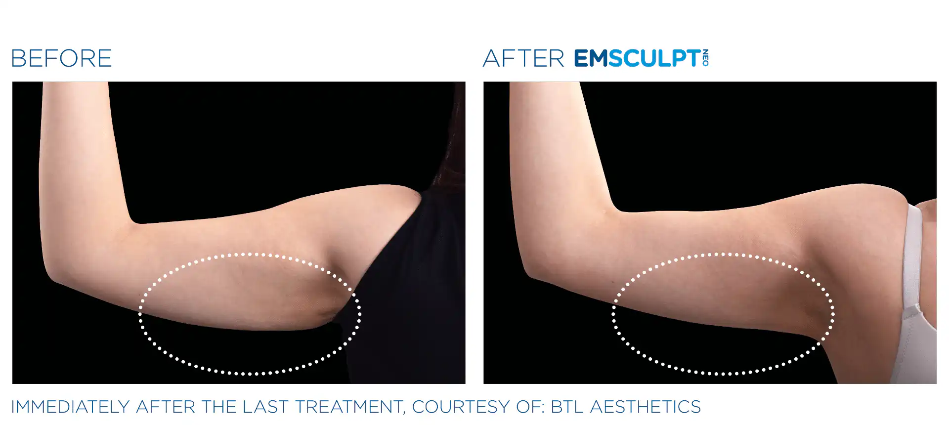 Emsculpt pictures Bronx, NYC